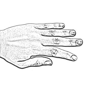 Lateral Instability hand graphic